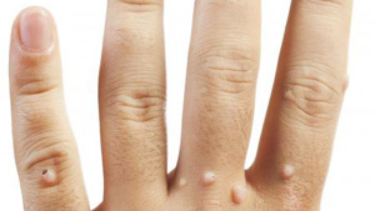 Hpv trasmissione mani