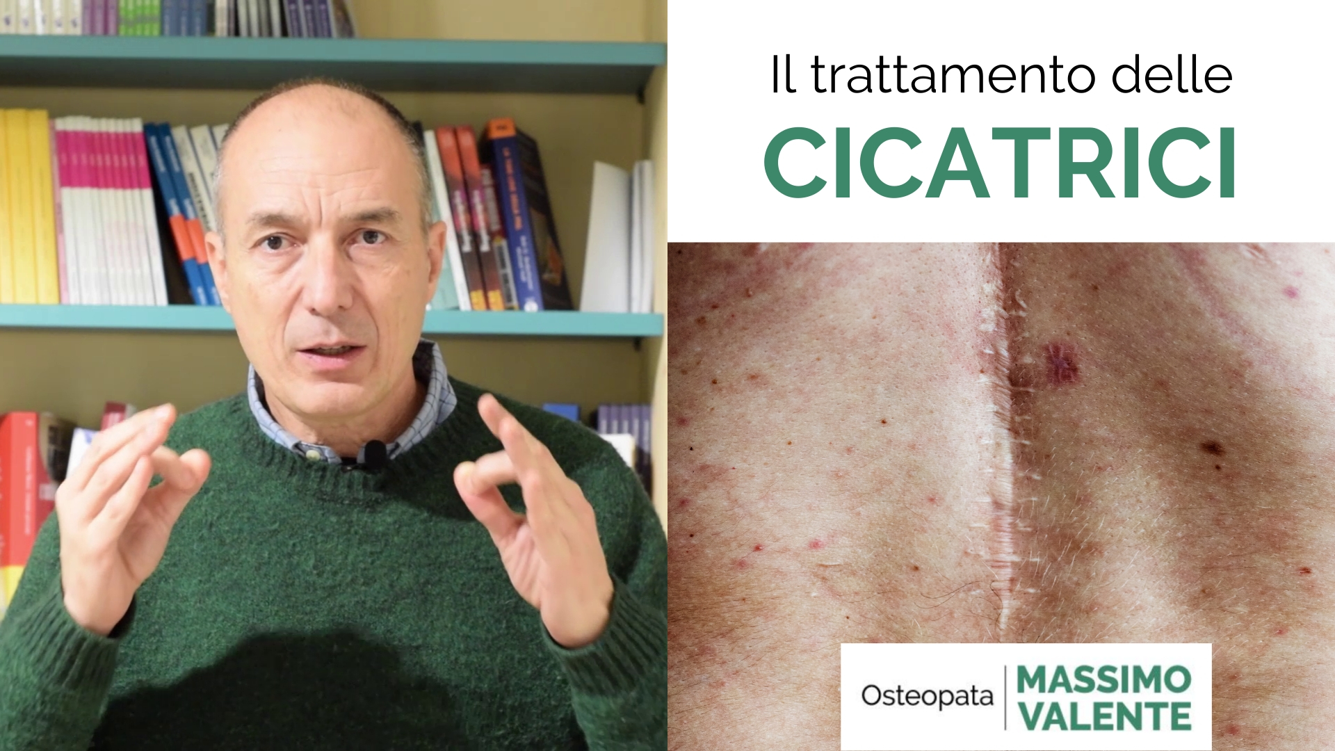 Il trattamento delle cicatrici – Osteopata Massimo Valente